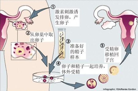 无精症成功案例